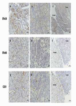 Expression patterns of ERα66 and its novel variant isoform ERα36 in lactotroph pituitary adenomas and associations with clinicop
